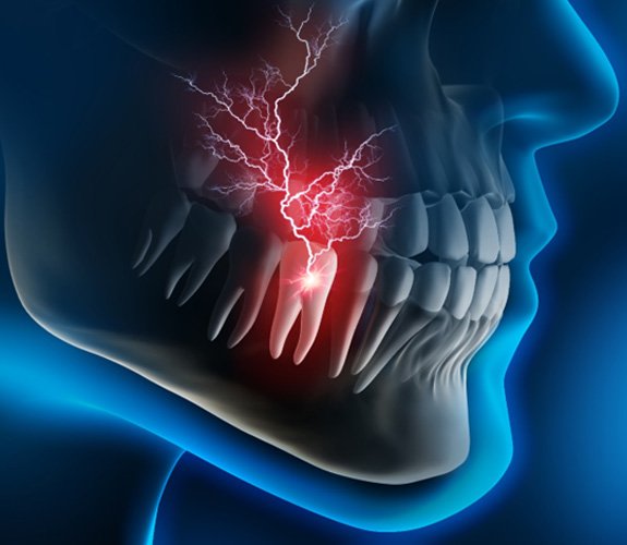 Illustration of tooth pain; dental emergency in Channahon, IL