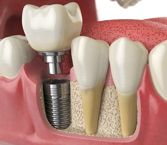 Benefits of dental implants in Channahon 