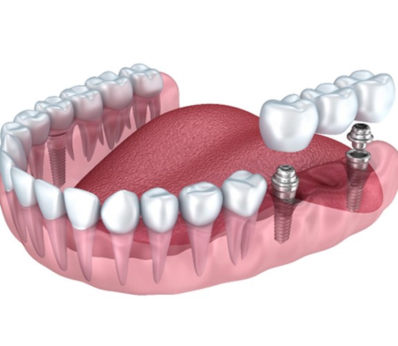 Benefits of dental implants in Channahon 