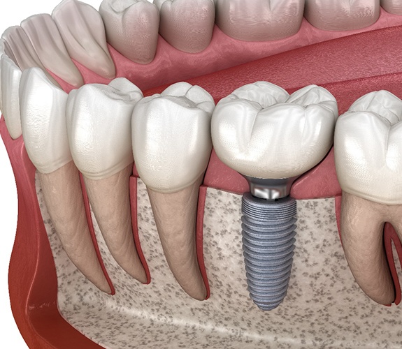 A dental implant in Channahon