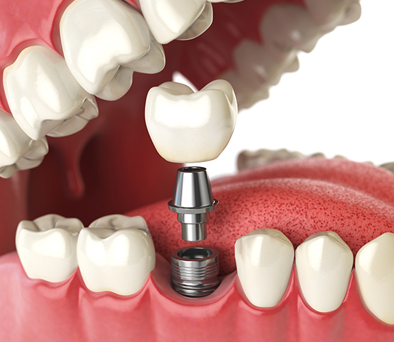 Animated dental implant tooth replacement