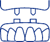 Drawing of implant denture