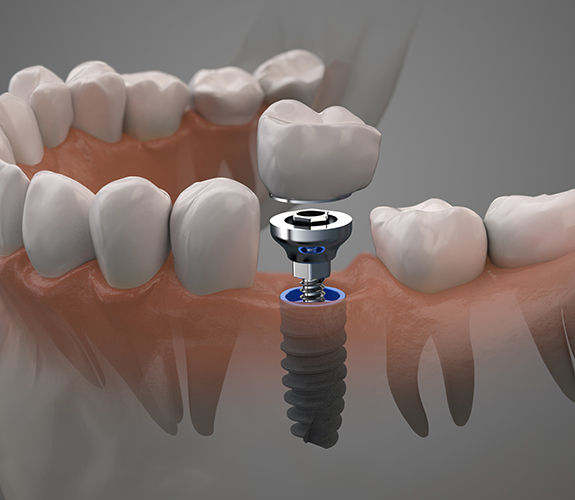 Animated dental implant supported dental crown placement