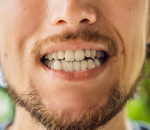 Closeup fo smile with Invisalign alignment tray