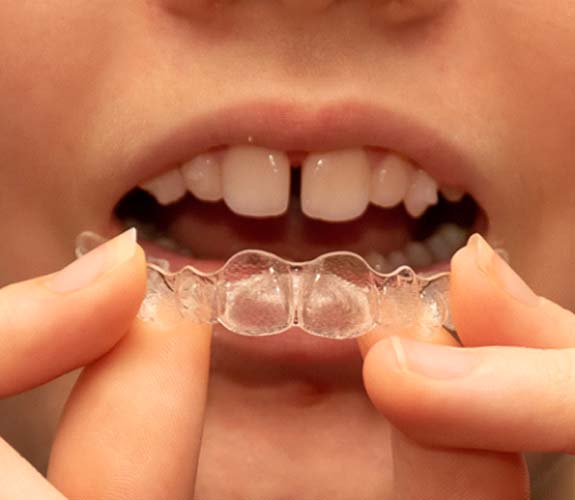 Invisalign Teen in Channahon