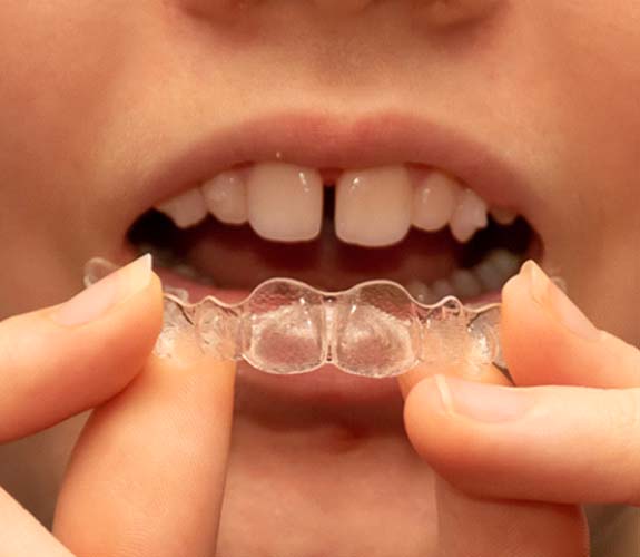 Clear Aligners Teen in Channahon