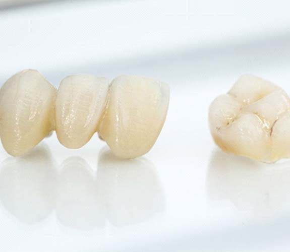 Closeup of metal-free dental crown in Channahon and metal-free bridge