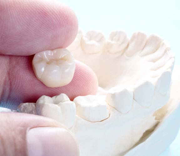Metal-free dental crown in Channahon being placed on model jaw