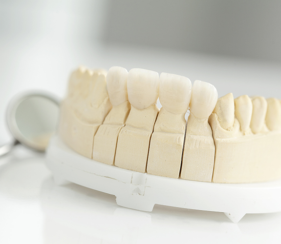 Model smile with dental bridge restoration replacing missing teeth