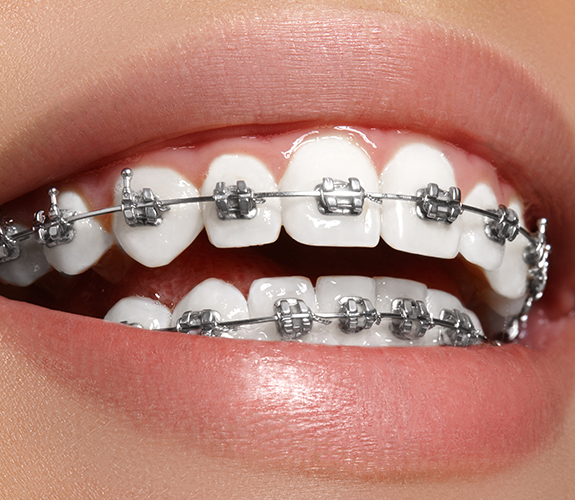 Closeup of metal braces on teeth