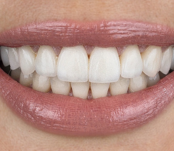 Close-up of straight smile after orthodontics in Channahon, IL