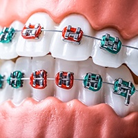 Close-up of braces for orthodontics in Channahon, IL