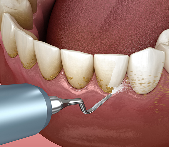 Closeup of smile during advanced periodontal therapy