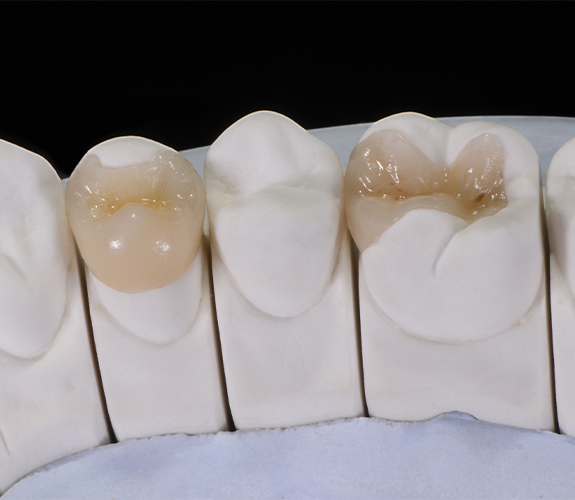 Model smile with inlay and onlay restorations