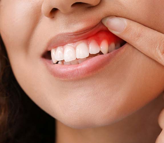 Patient pulling up lip to show signs of gum disease