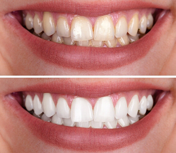 before and after teeth whitening