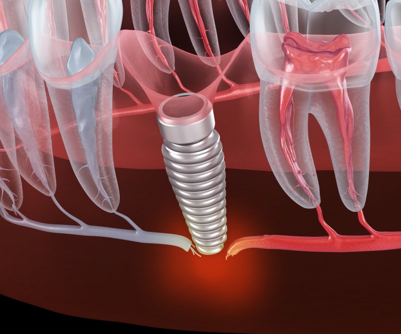 dental implant failure  