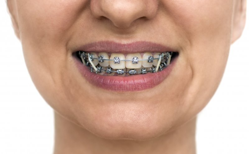 person wearing traditional braces